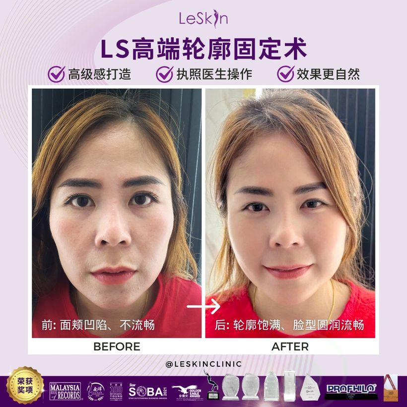 Ellansé before and after — real LS patient result