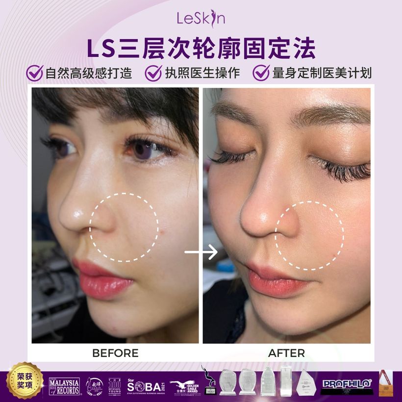 Ellansé before and after — real LS patient result