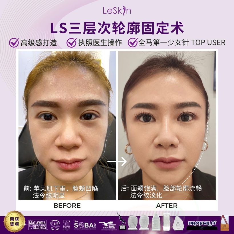 Ellansé before and after — real LS patient result